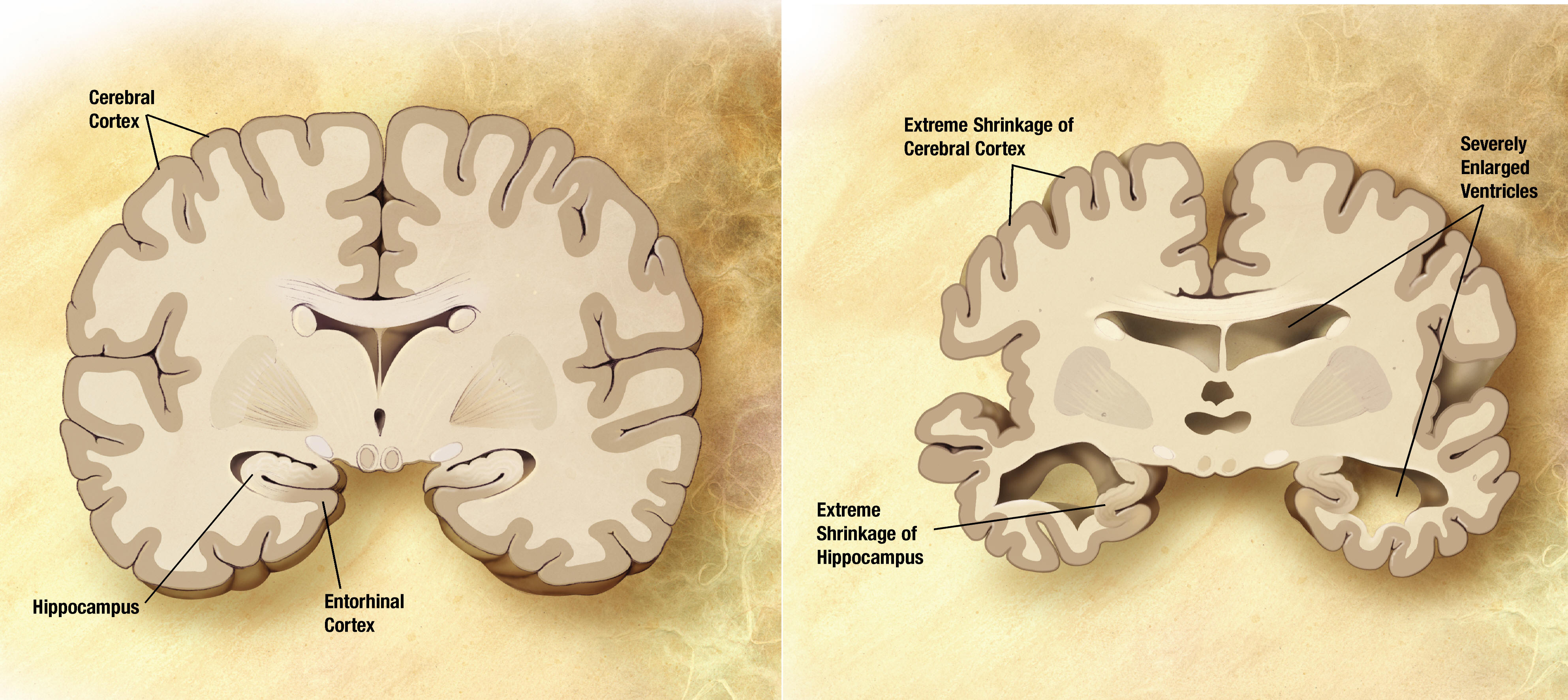 alzheimer comparaison